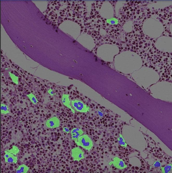 Рак костного мозга, подсвеченный нейронной сетью